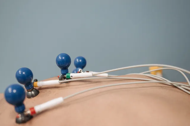 Detailed image of ECG electrodes on a patient's chest, capturing a medical procedure. Lead-Scoring umsetzen